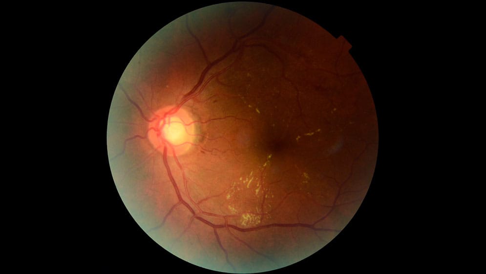 Retinar: inteligencia artificial argentina para prevenir la ceguera por diabetes