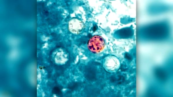 San Francisco reporta primer caso de ciclosporiasis vinculado a brote nacional por lechuga contaminada