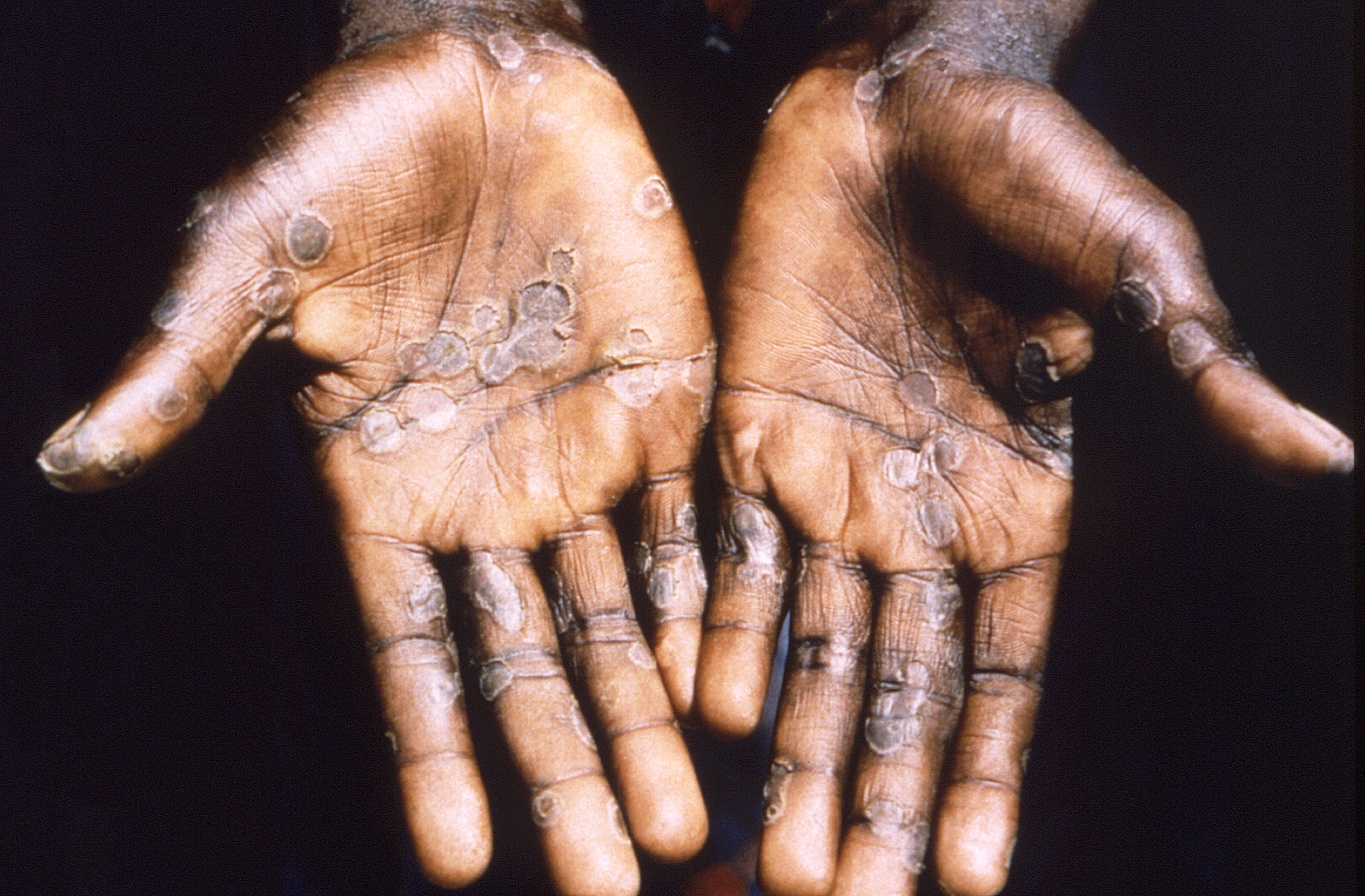 Close-up of a patient's hands, on black background, showing lesions from the monkeypox virus, the Democratic Republic of the Congo, 1997. Courtesy CDC/Mahey et al. (Photo via Smith Collection/Gado/Getty Images)