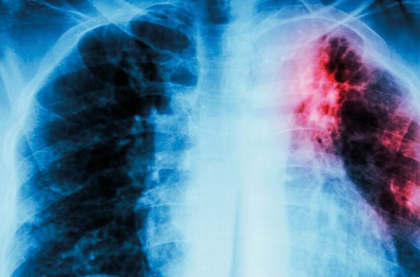  Tuberculosis, al alza en 13 estados del país – La Razón de México