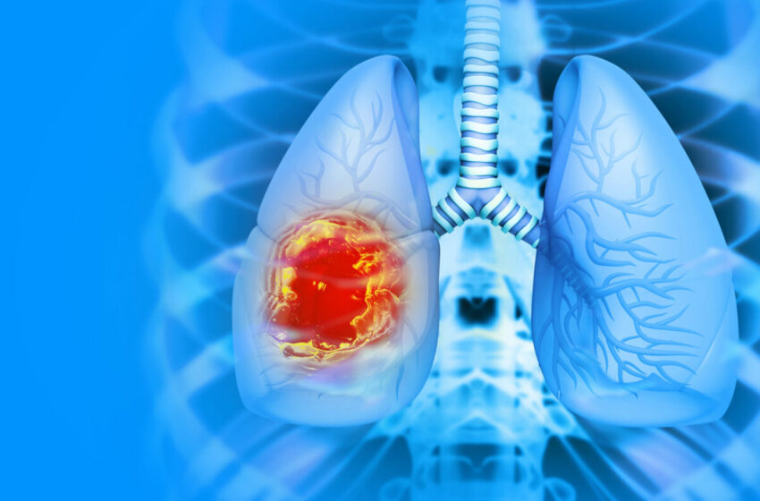  España, la excepción en Europa: la mortalidad por cáncer de pulmón en mujeres aumentará en 2026