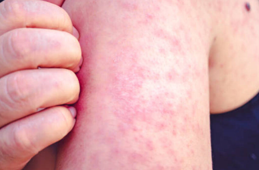  OPS lanza alerta epidemiológica por sarampión a casi 100 días del Mundial 2026 – UnoTV